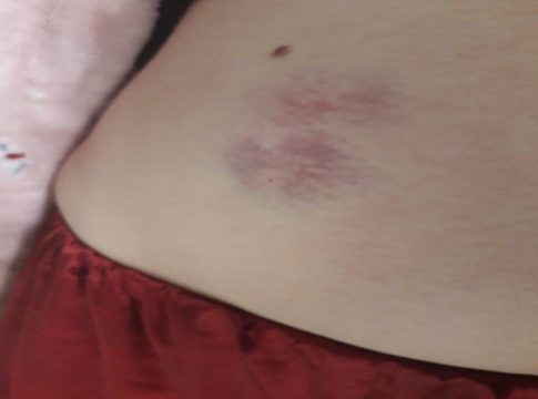 Έχω πολύ πόνο … βουβό πόνο…